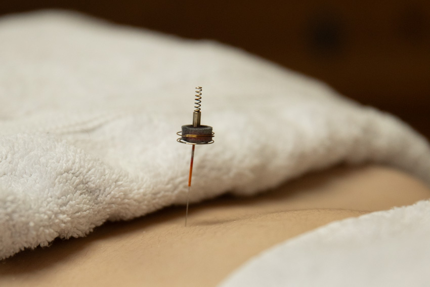 Tussen twee witte handdoeken zie je een stukje blote buik. In de buik steekt een acupunctuurnaald met daarop een metalen geveerd houdertje met een gloeiend ringetje wierrook moxa. De naald zelf gloeit ook, en zo wordt warmte het lichaam in gebracht. Foto door Maja Elders