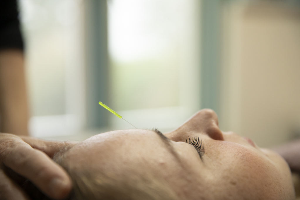 Je kijkt vanaf rechtsboven op een liggend gezicht. Er steekt een acupunctuurnaald tussen de wenkbrauwen en de hand van de acupuncturiste ligt op het hoofd.